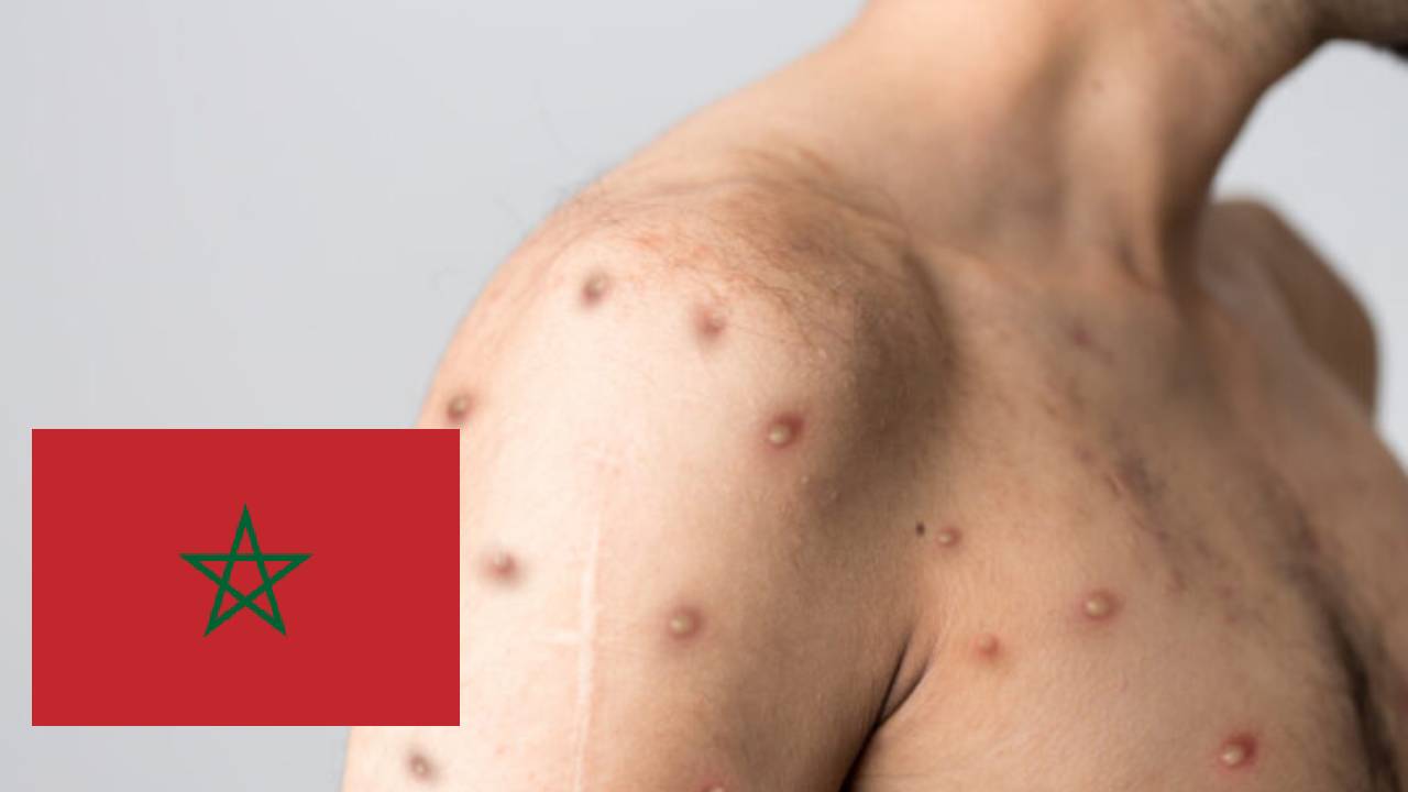 المغرب يُسجّل أول حالة إصابة مؤكّدة بمرض جدري القردة