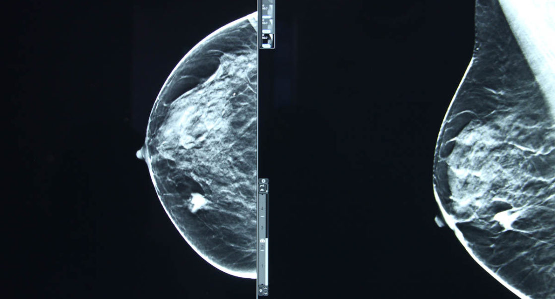 Surtout chez les jeunes : le cancer du sein fait de véritables ravages en Algérie, alerte le Pr Fissah !￼